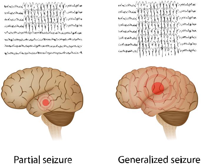 Epilepsy Epilepsy Mumbai
